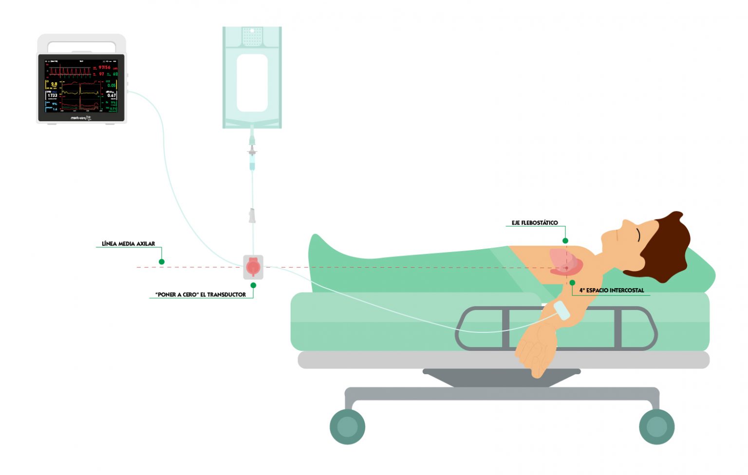 Canalización arterial ecoguiada en 6 pasos Campus Vygon España