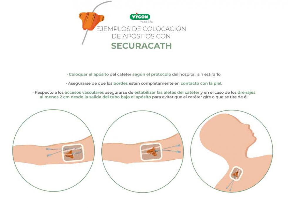 Ejemplos de colocación de apósitos con SecurAcath Campus Vygon España