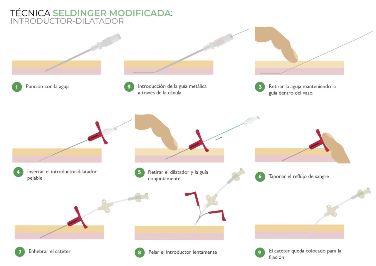 Canalización PICC neonatal Técnica Seldinger modificada cánula pelable