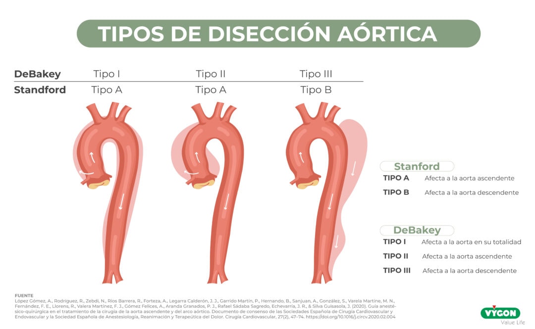 Monitorización hemodinámica en la cirugía de aorta ascendente y arco