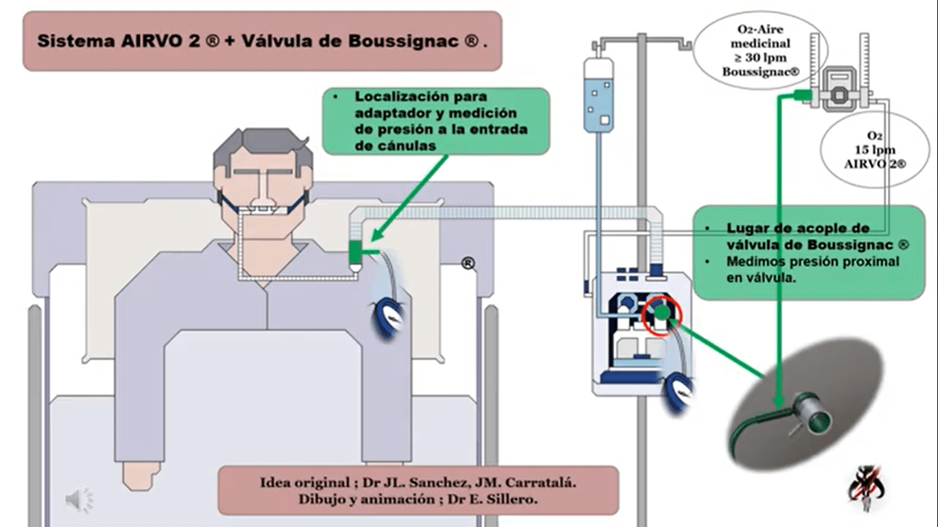 CPAP Nasal 0 - UcinMedica - Evolucionamos juntos por la salud