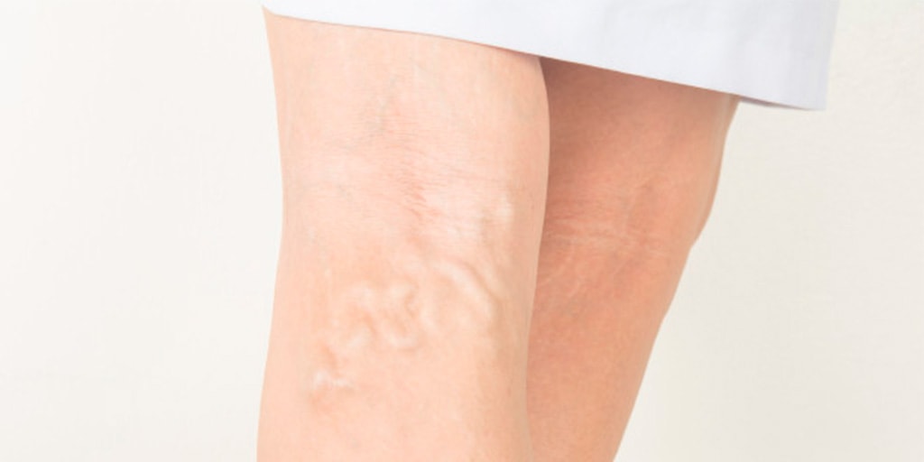 ¿En qué consiste la escleroterapia?