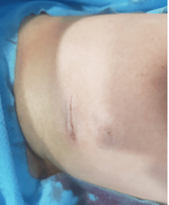 PICC-port recién colocado con cianoacrilato- Fuente: Glória Ortiz