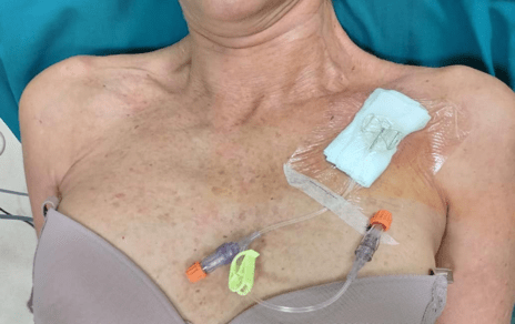Chest port