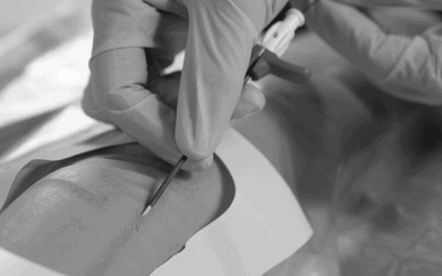 La técnica Seldinger: ¿cuándo usar el método clásico o modificado?