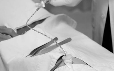 ¿Qué catéter umbilical elegir?: Material y luces del dispositivo