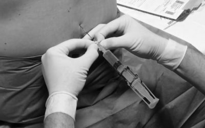 Cómo detectar el espacio epidural y evitar complicaciones en la técnica