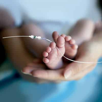 acceso-vascular-neonatal-400