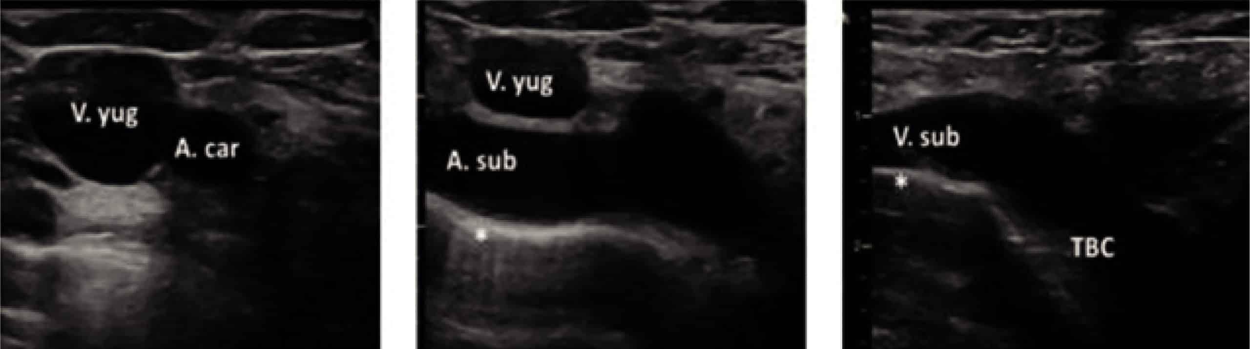 subclavia