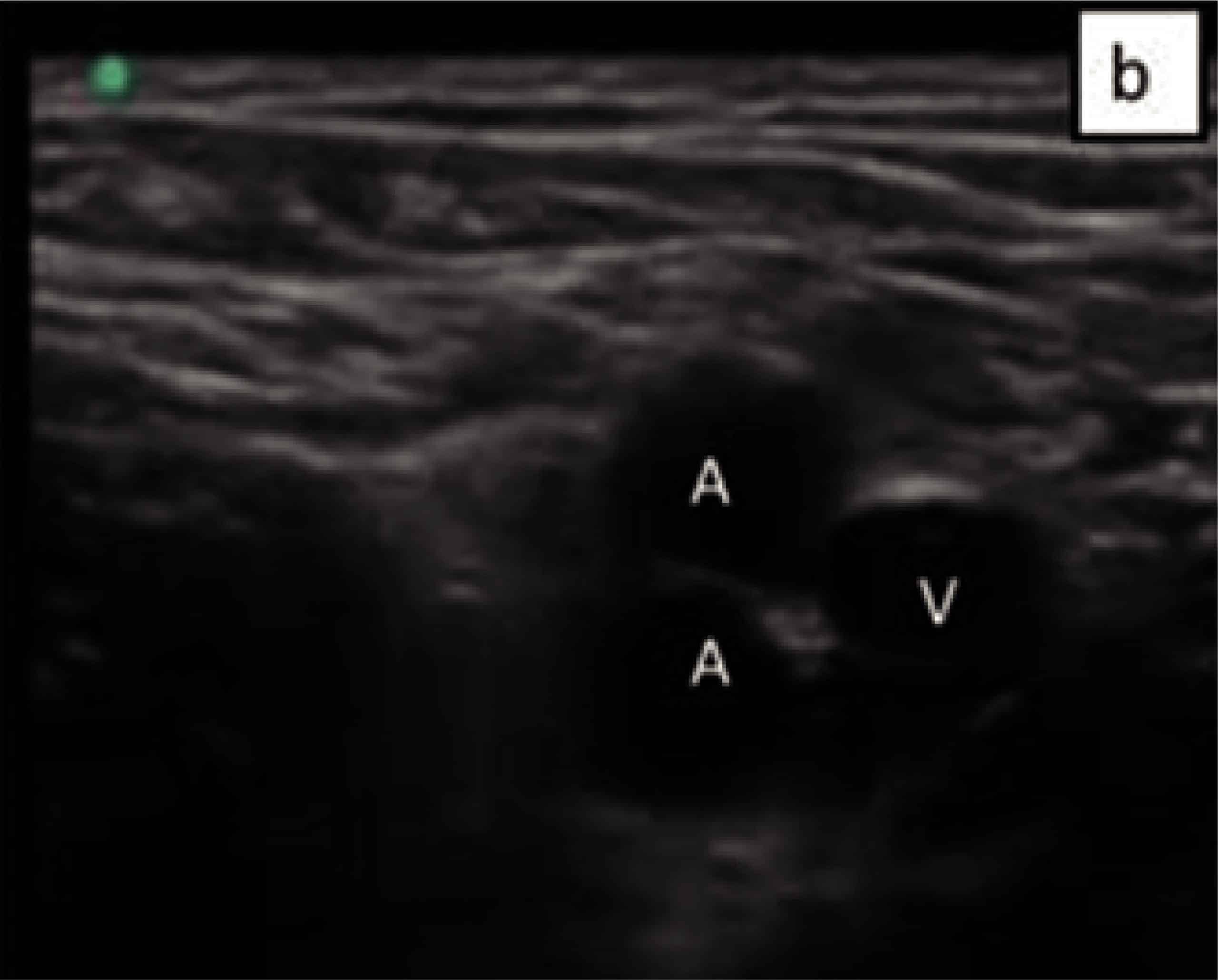femoral eco