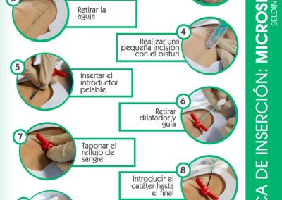 Póster técnica de inserción Microseldinger