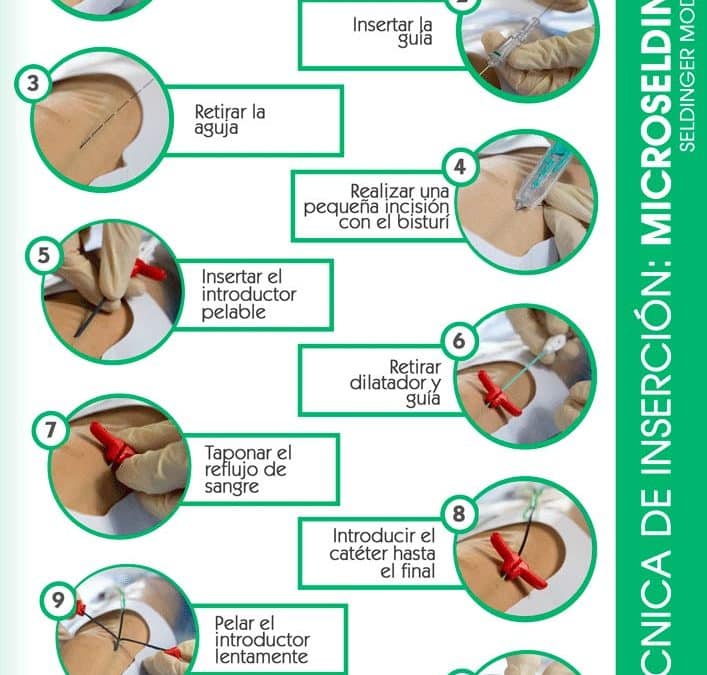Póster técnica de inserción Microseldinger