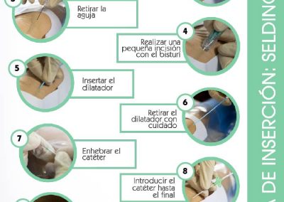 Póster técnica de inserción Seldinger pura