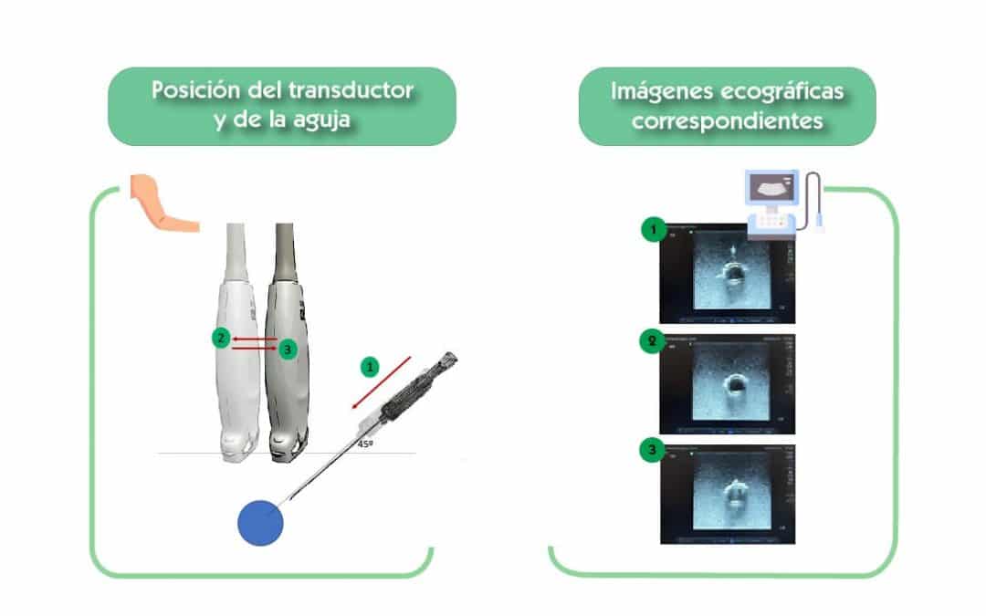 Técnica ecográfica dinámica en plano transversal