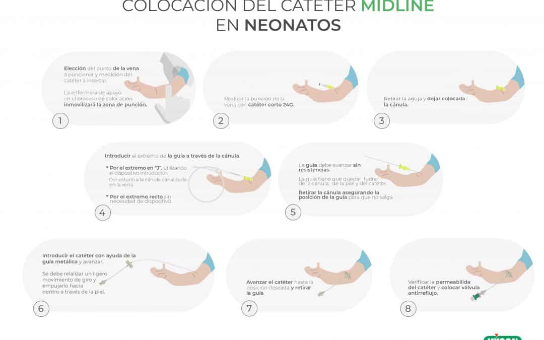 Colocación de catéter midline en neonatos