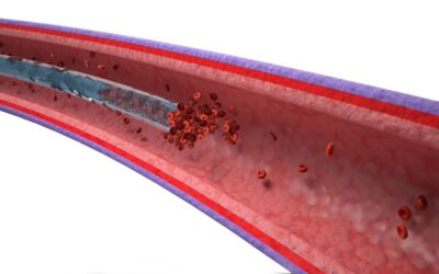 Erhöhtes Thromboserisiko mit PICCs – Mythos oder Fakt?