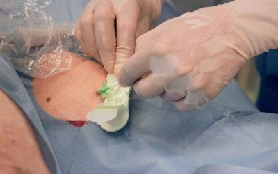 Wie wird der Midline-Katheter verwendet? Platzierungs- und Pflegeprotokoll!