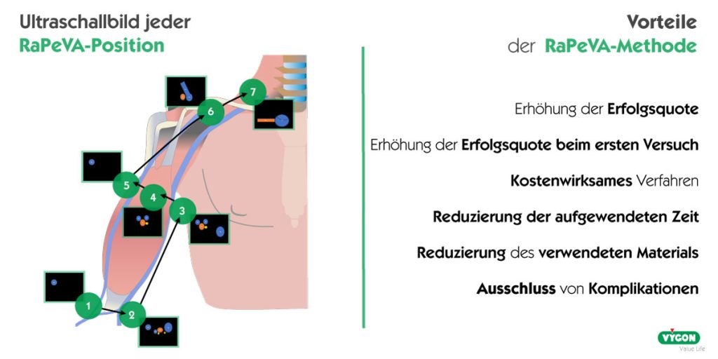 Vorteile-der-RaPeVA-Methode