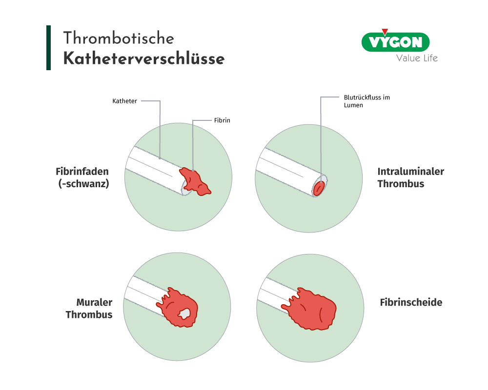 Thrombotische-Katheterverschlüsse