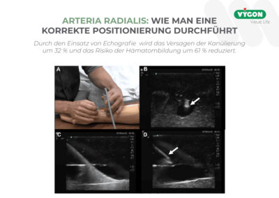 Arteria Radialis – Wie man eine korrekte Positionierung durchführt