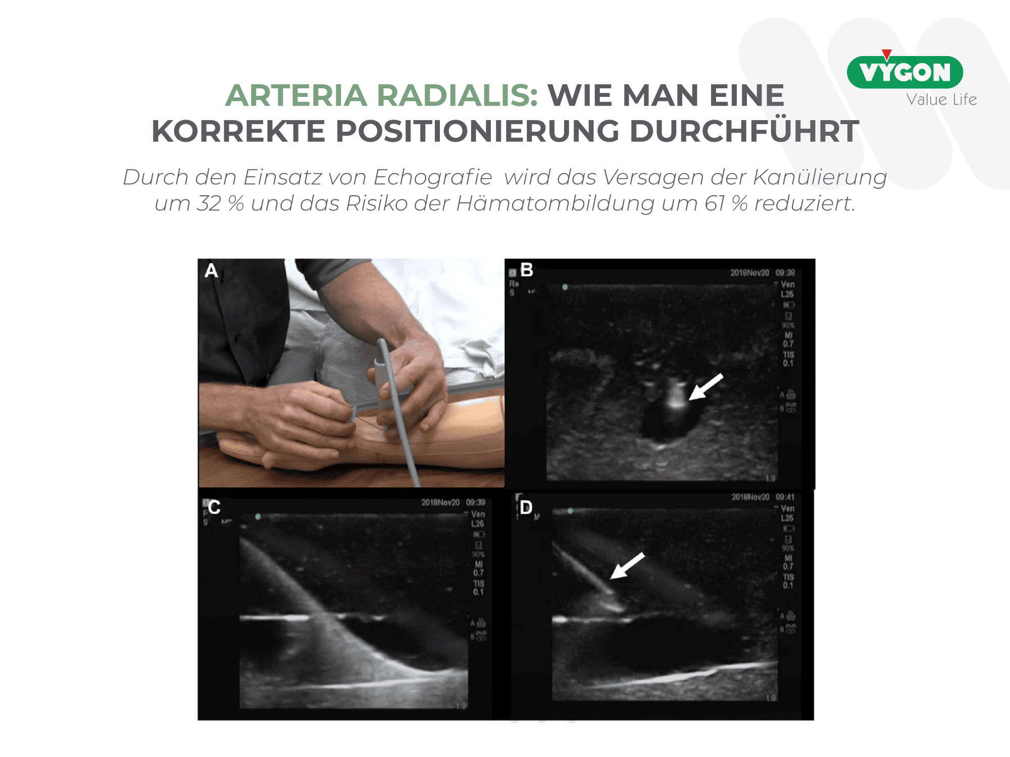 Arteria Radialis - Wie man eine korrekte Positionierung durchführt