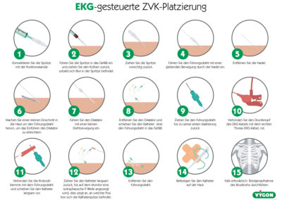 EKG-gesteuerte ZVK-Platzierung