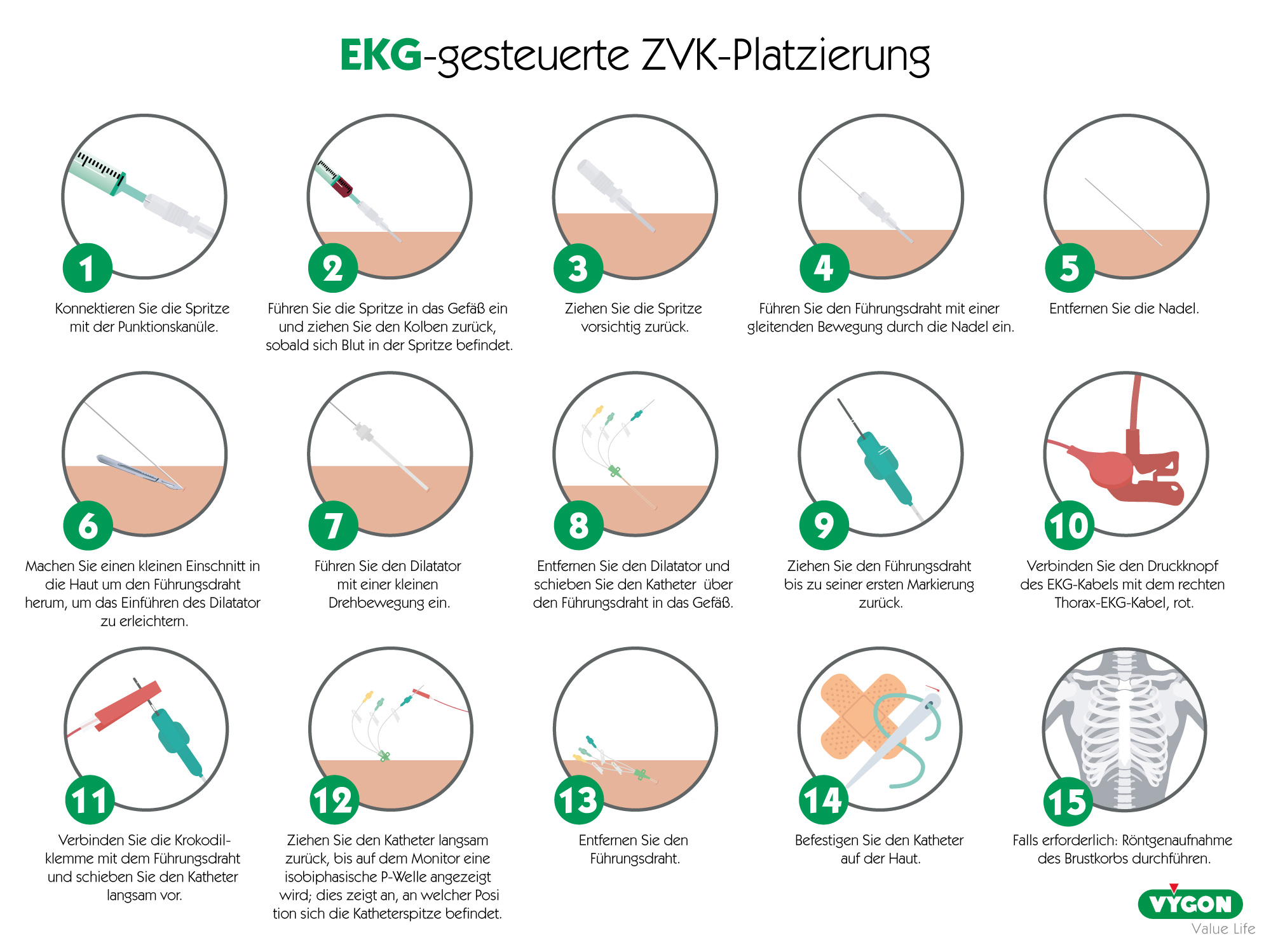 EKG-gesteuerte ZVK-Platzierung