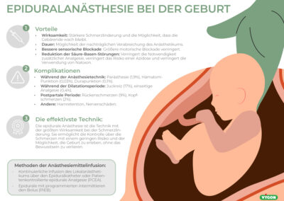 Epiduralanästhesie bei der Geburt