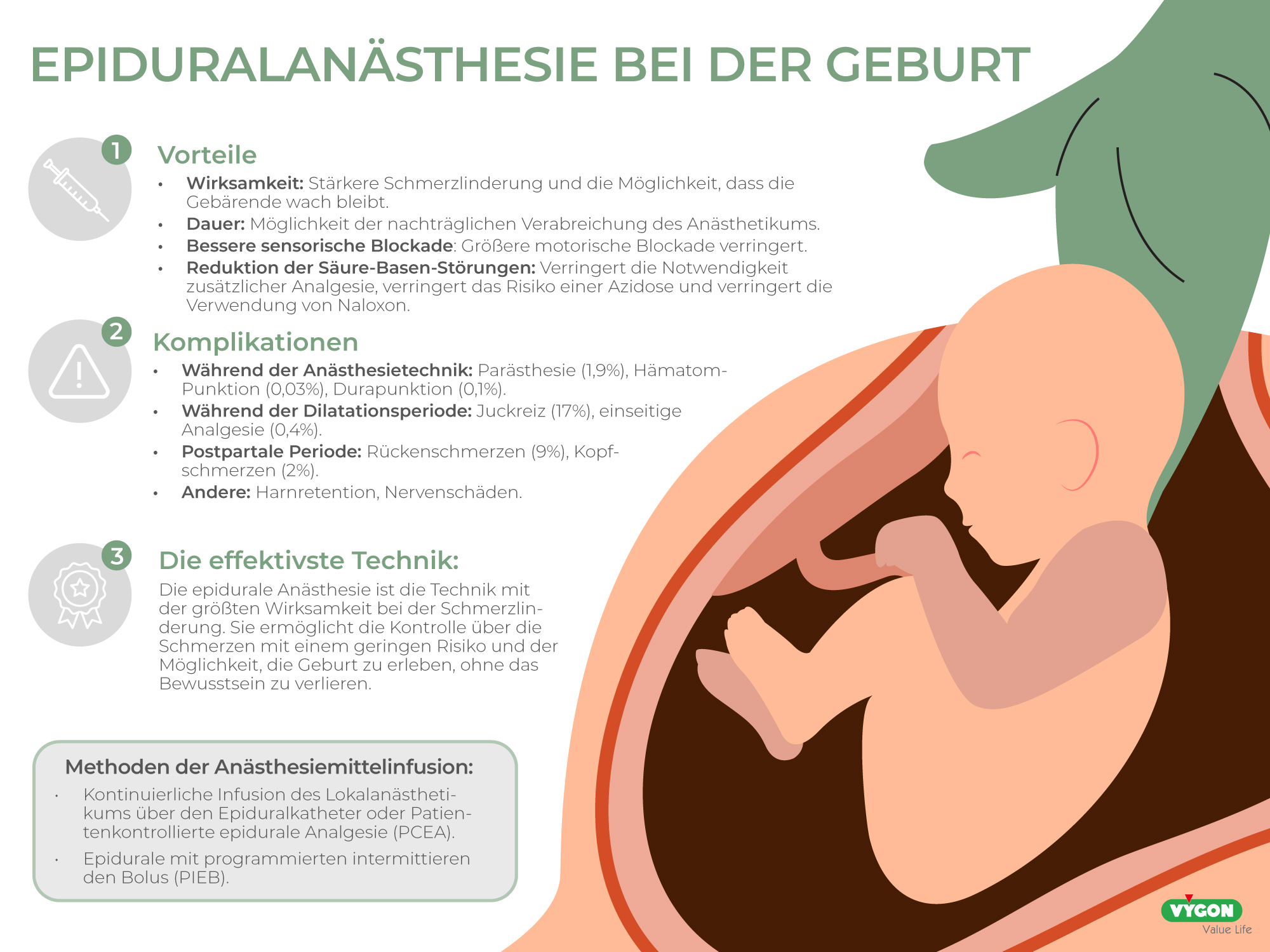 Epiduralanästhesie bei der Geburt