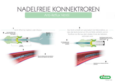 Nadelfreie Konnektoren – Anti-Reflux Ventil