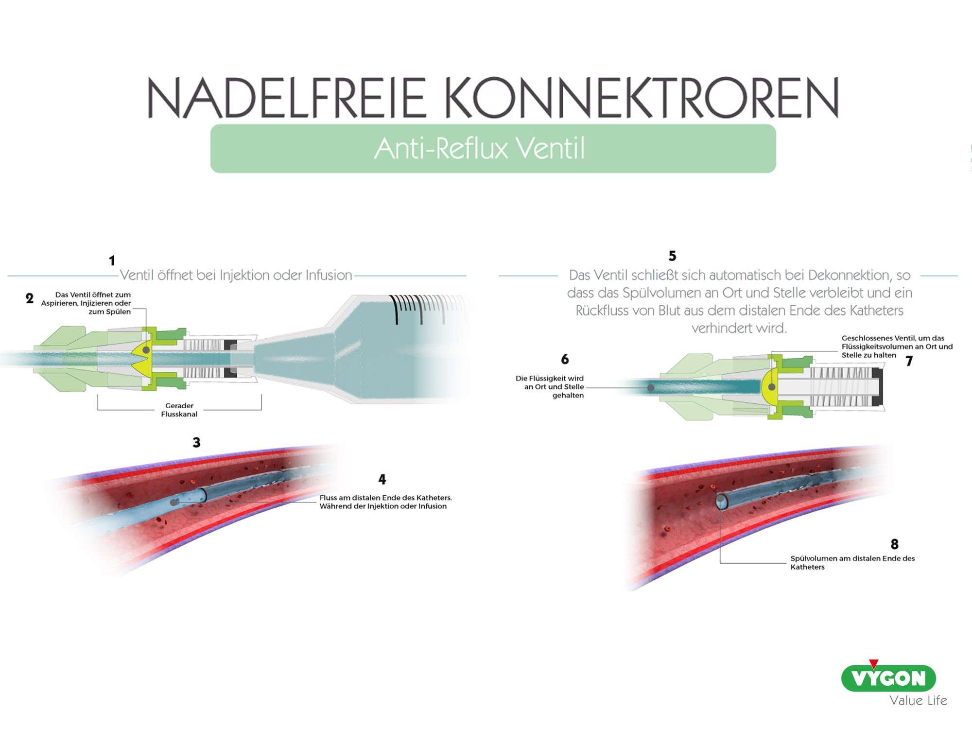 Nadelfreie Konnektoren - Anti-Reflux Ventil