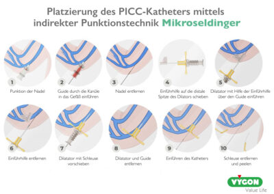 Platzierung des PICC-Katheters mittels indirekter Punktionstechnik – Mikroseldinger