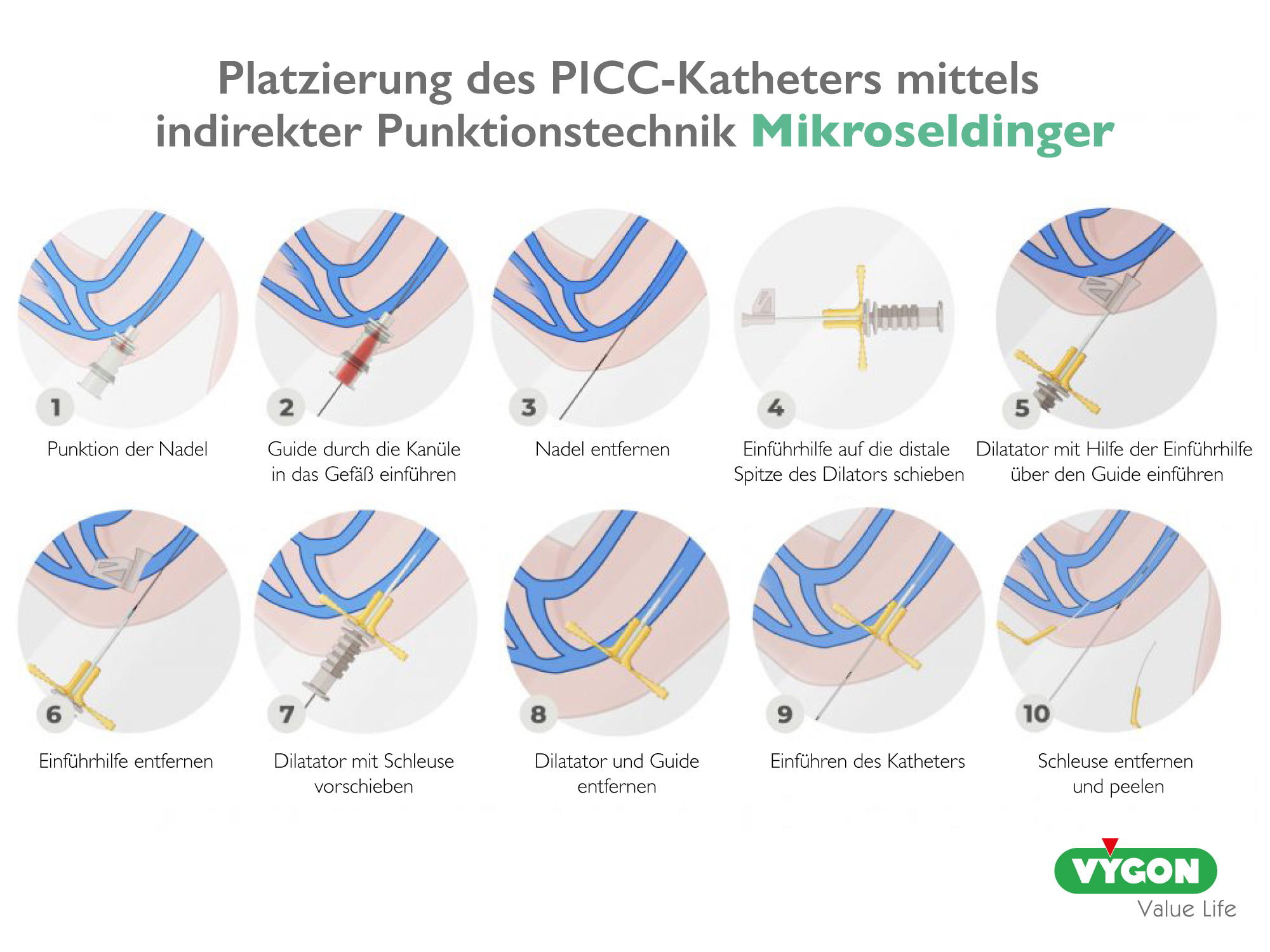 Platzierung des PICC-Katheters mittels indirekter Punktionstechnik - Mikroseldinger