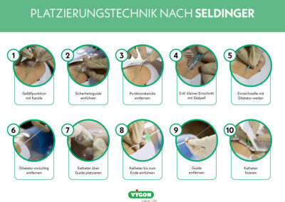 Platzierungstechnik – Seldinger-Technik