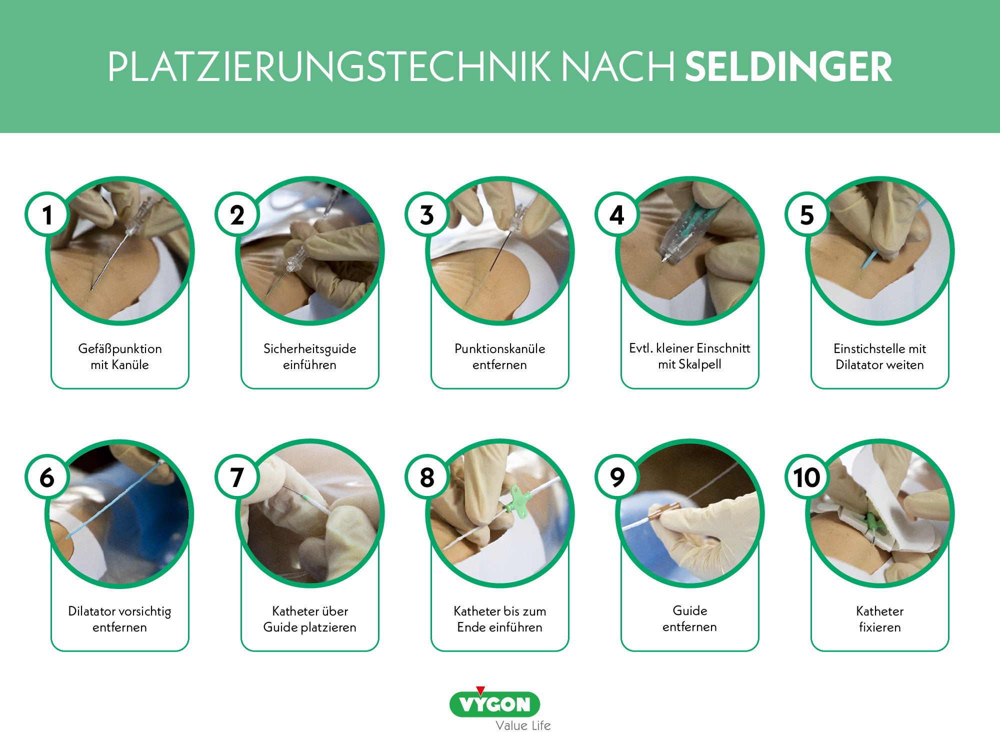 Platzierungstechnik - Seldinger-Technik