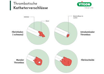 Thrombotische Katheterverschlüsse