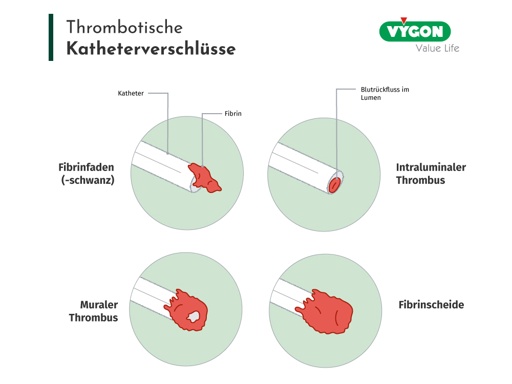 Thrombotische Katheterverschlüsse