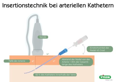 Insertionstechnik bei arteriellen Kathetern