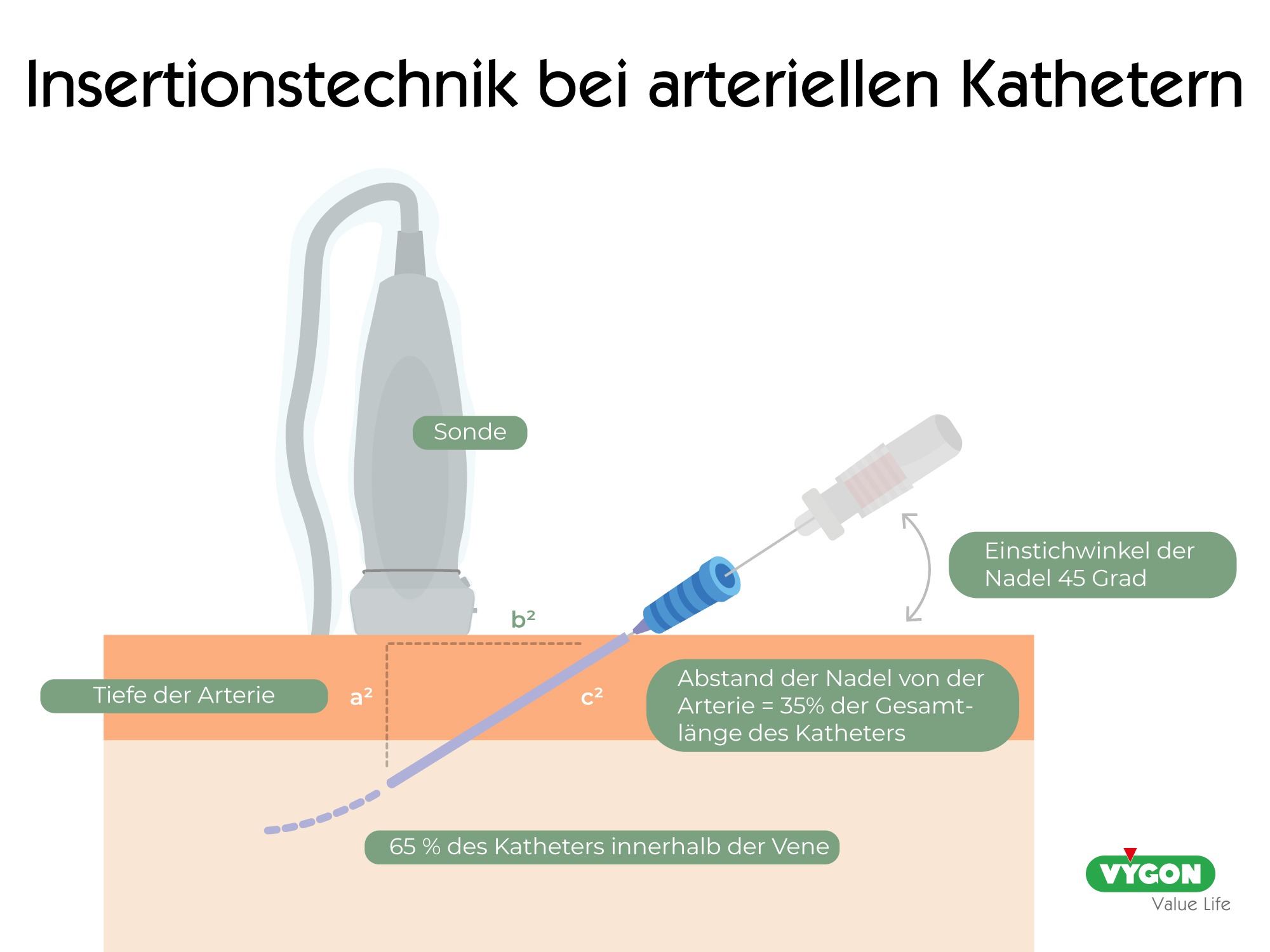 Insertionstechnik bei arteriellen Kathetern