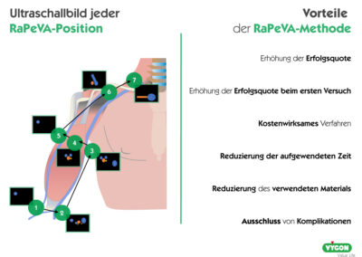 Ultraschallbilder und Vorteile der RaPeVA-Methode