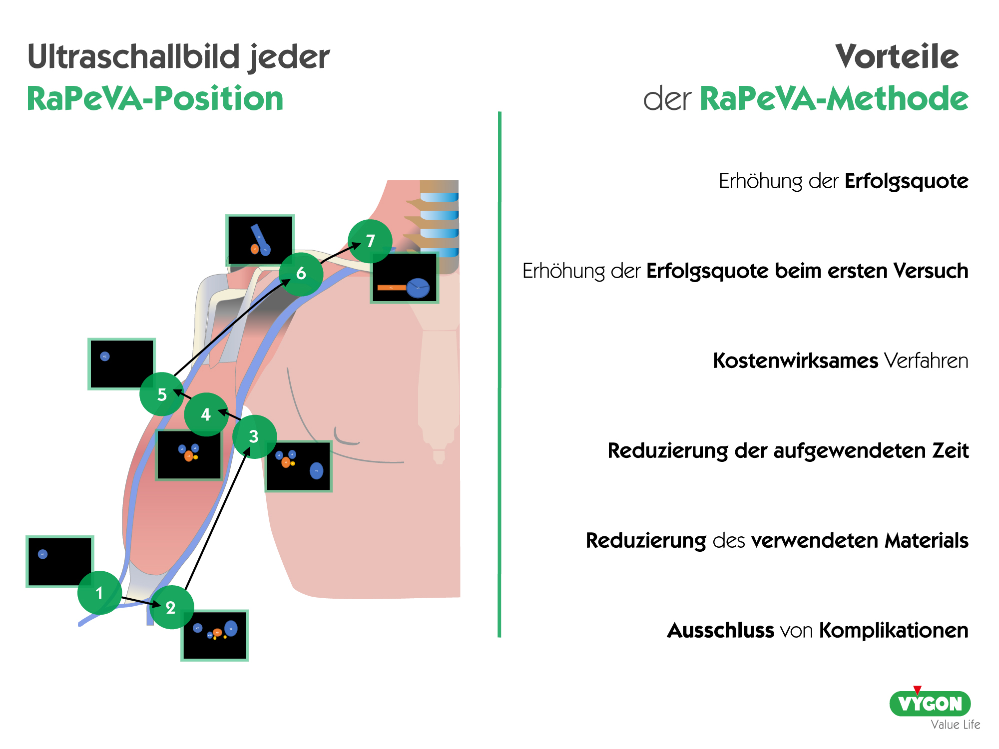 Ultraschallbilder und Vorteile der RaPeVA-Methode