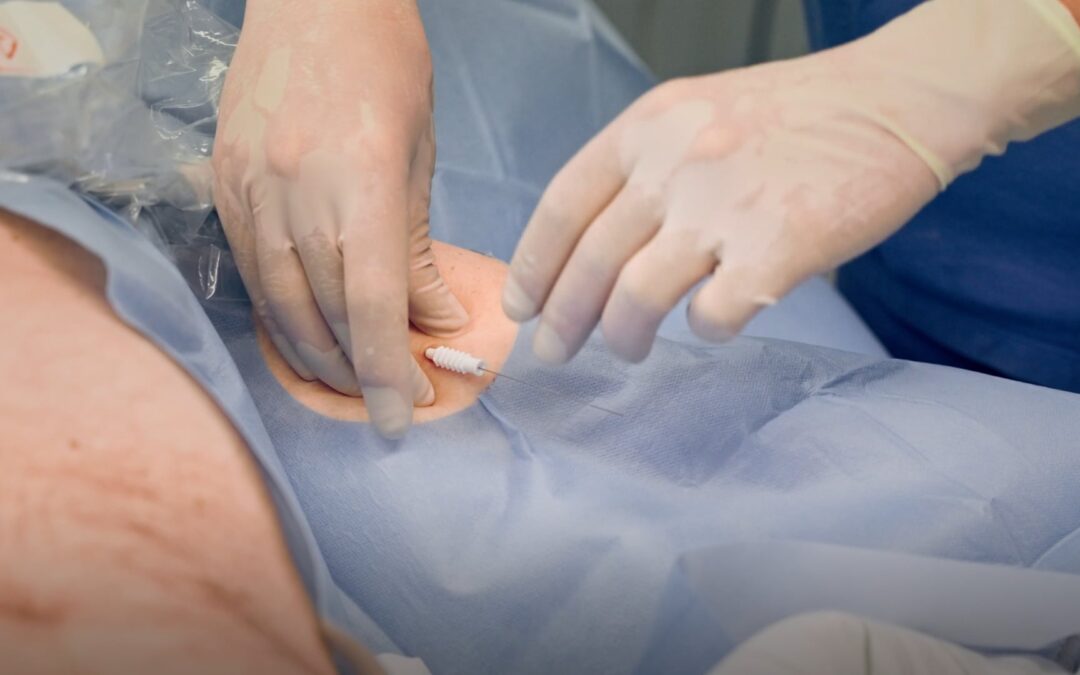 Anlage Mini-Midline-Katheter – Platzierung mittels Ultraschall
