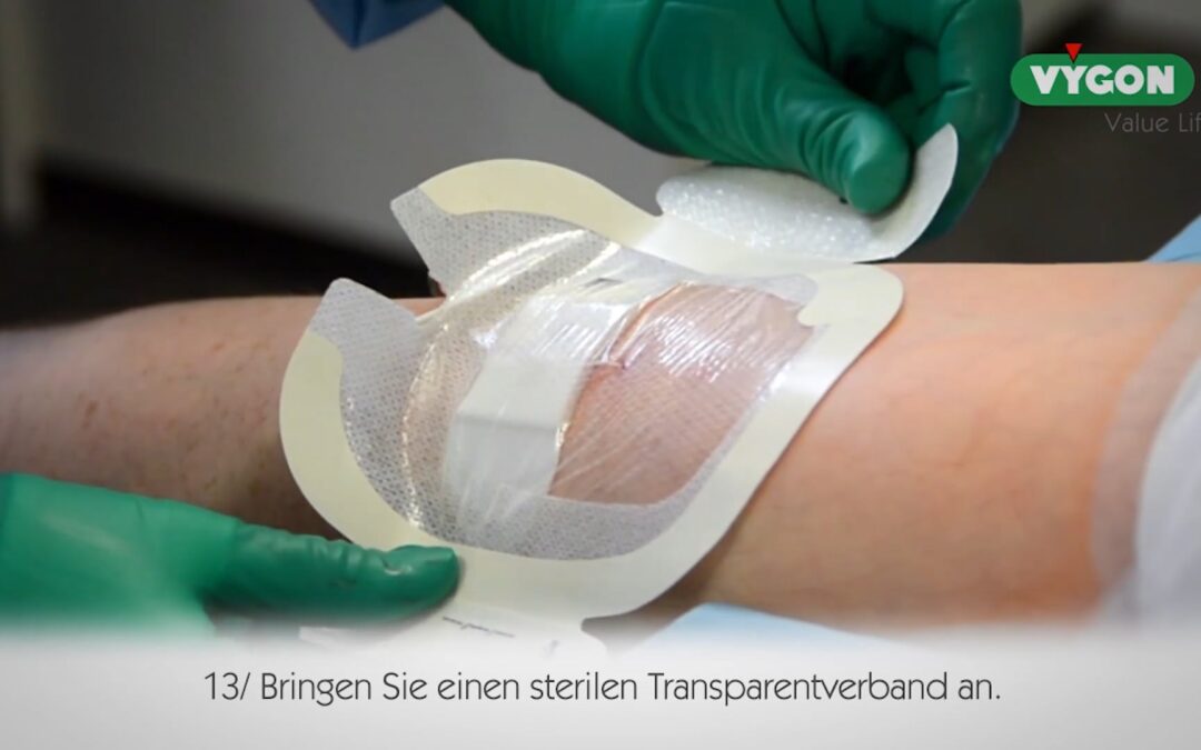 Anlage Mini-Midline-Katheter – Platzierung im Oberam