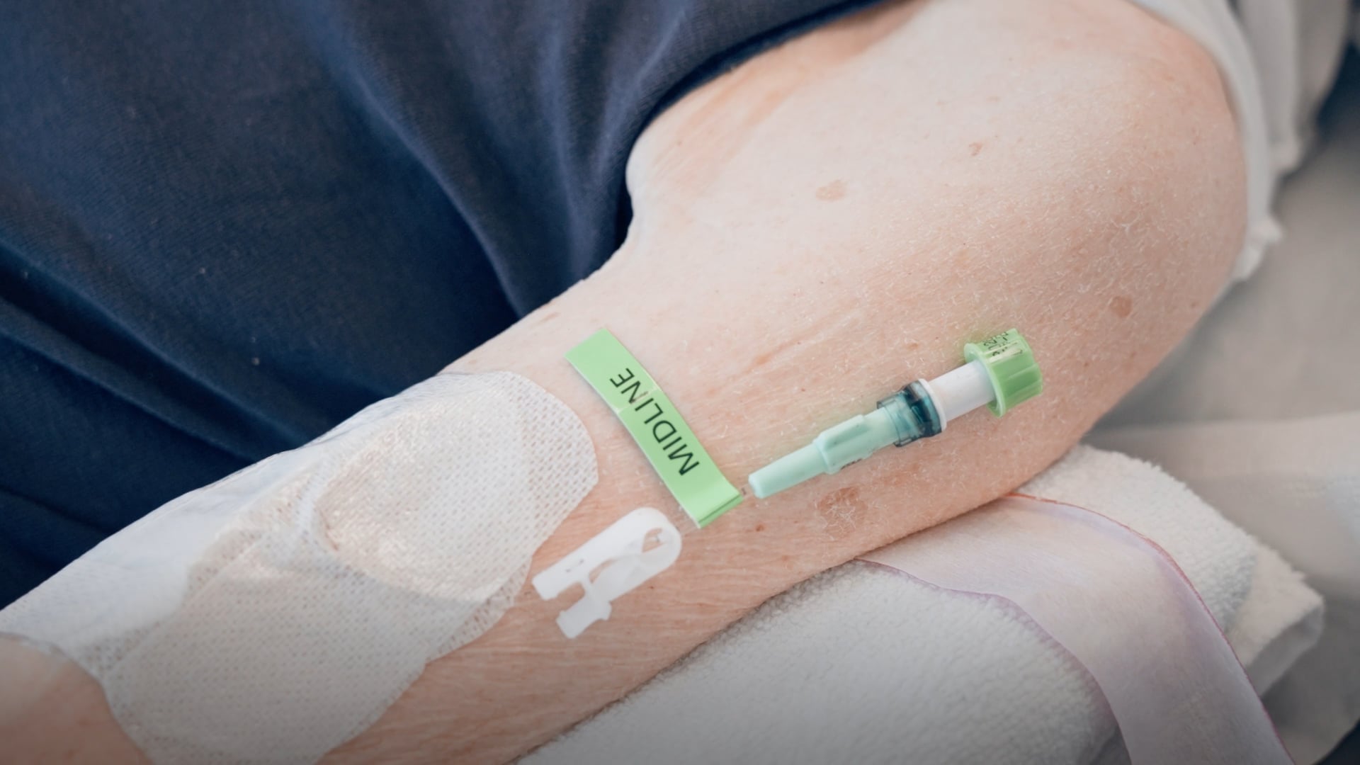 Anlage Midline-Katheter – Bettseitige Platzierung mittels Ultraschall