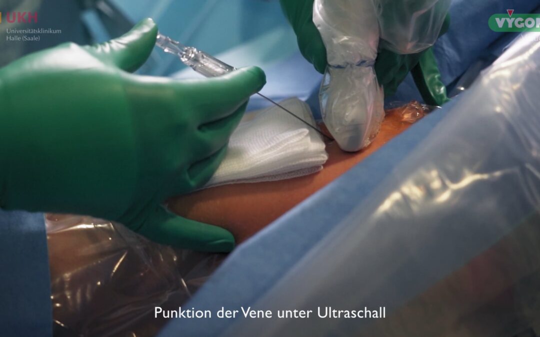 Anlage PICC-Katheter – Platzierung mittels „Over the wire“-Technik