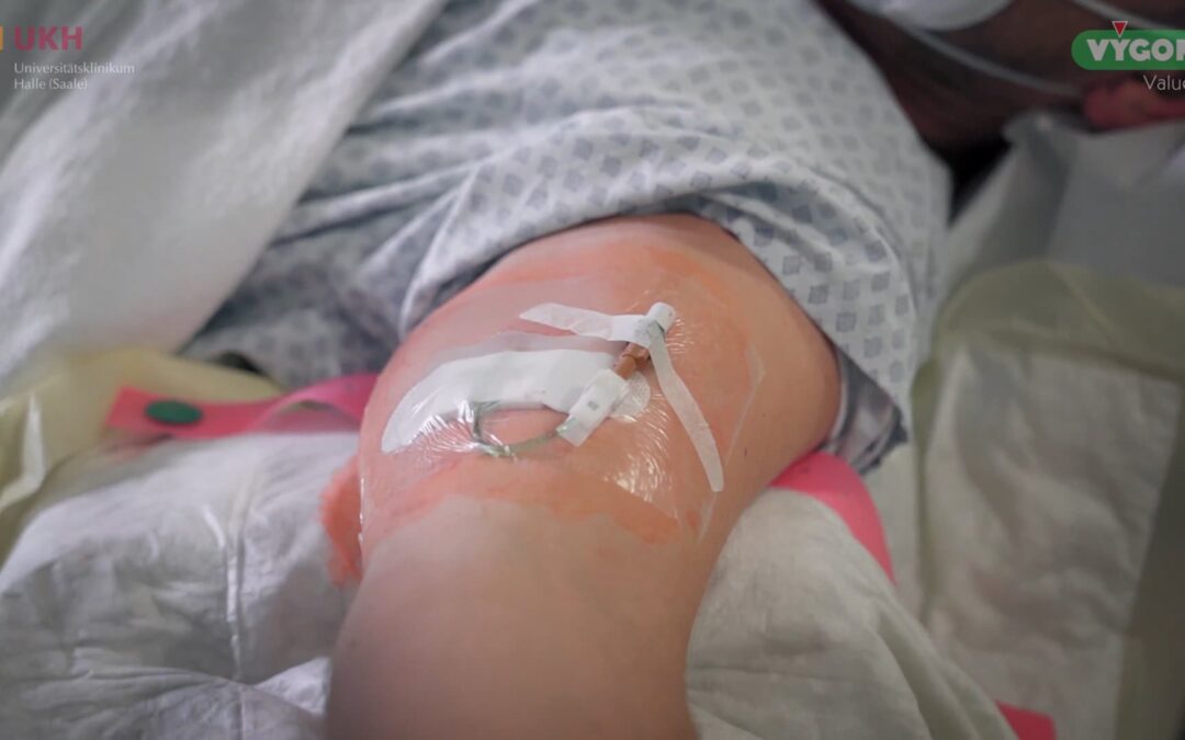 Anlage PICC-Katheter – Platzierung mittels „Over the wire“-Technik