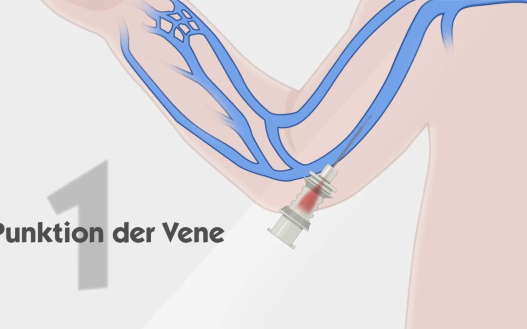 Anwendung des Mikroseldinger-Einführbestecks in der Neonatologie
