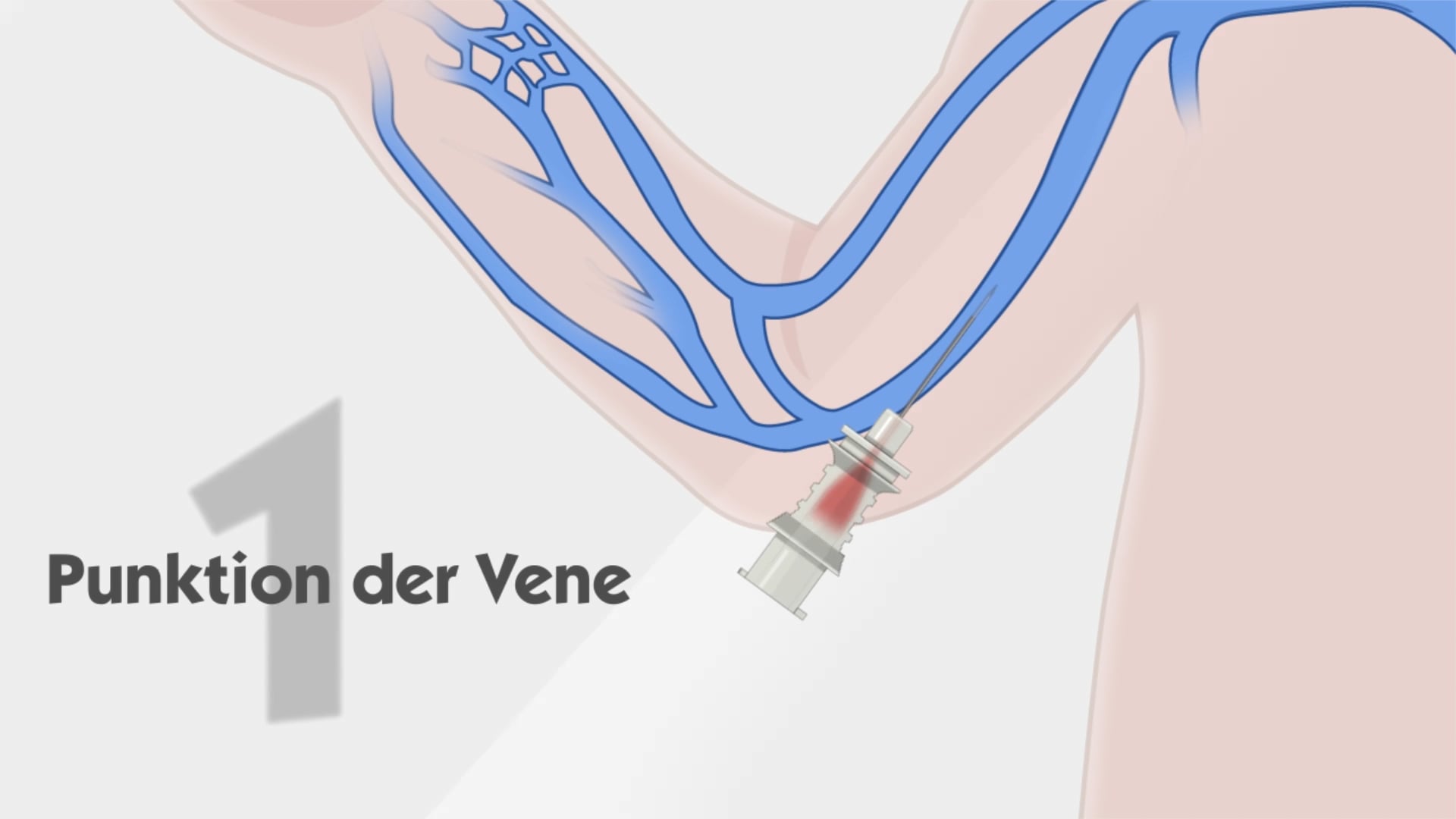 Anwendung des Mikroseldinger-Einführbestecks in der Neonatologie