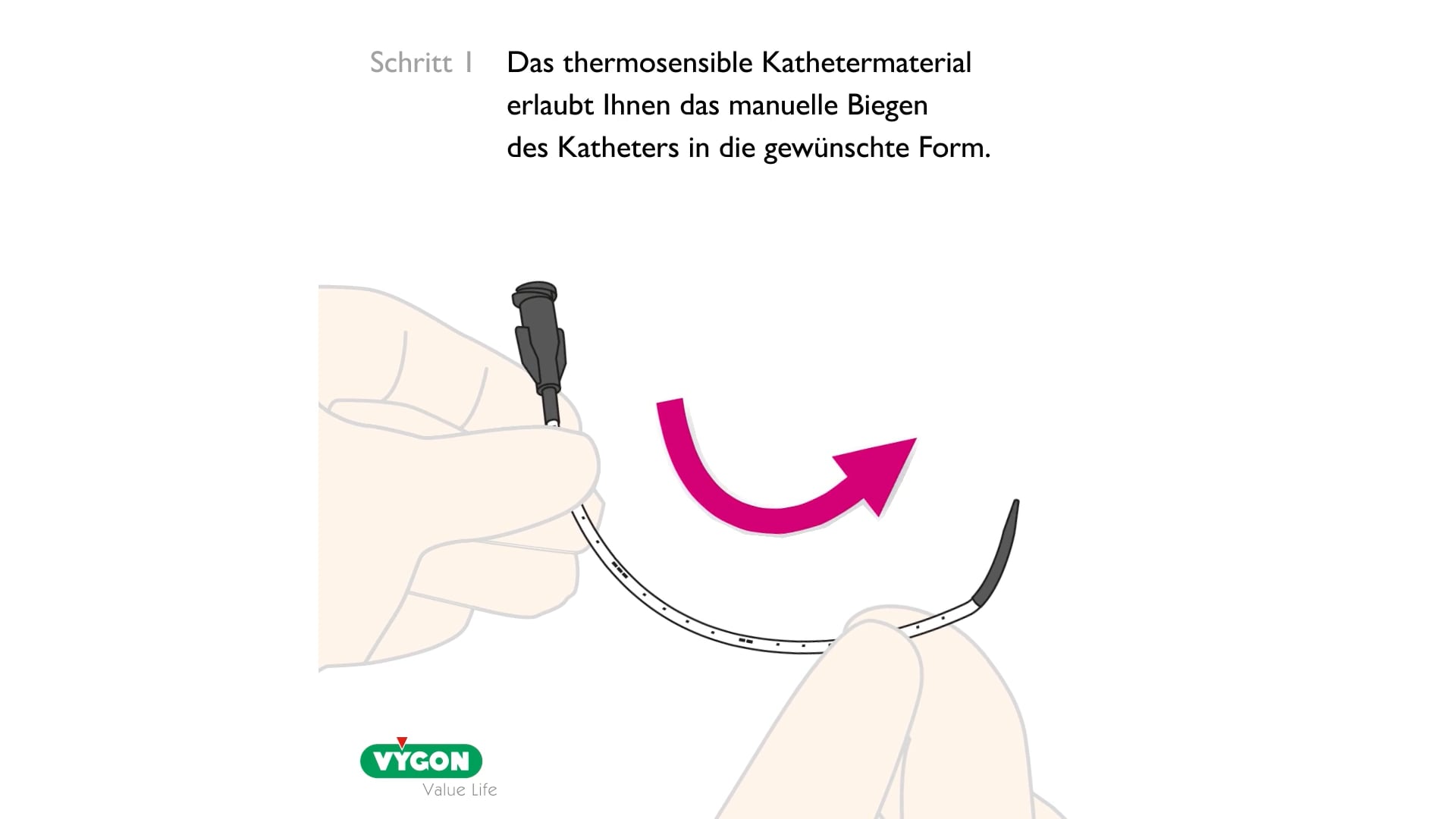 Applikationskatheter zur Durchführung der LISA-Methode