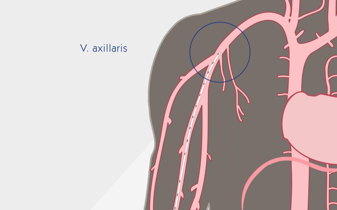 Informationen Midline-Katheter